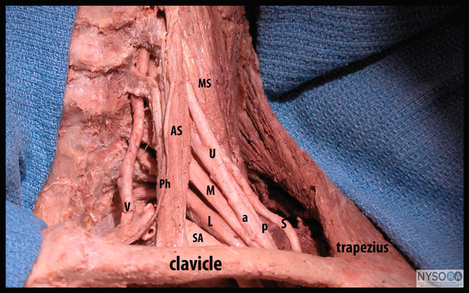 Supraclavicular Brachial Plexus Block - NYSORA The New York School of