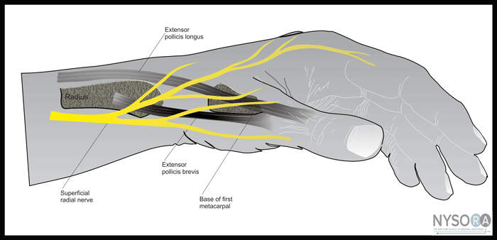 Wrist Block Nysora The New York School Of Regional Anesthesia