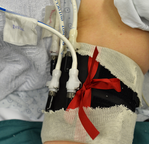 Bier Block - NYSORA The New York School of Regional Anesthesia