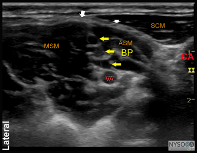 상완신경총 차단술 (Brachial plexus block, BPB) : 네이버 블로그