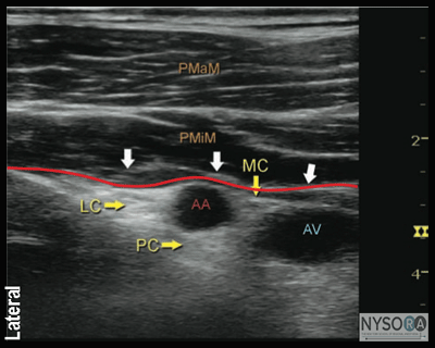 nysora - the new york school of regional anesthesia - ultrasound nysora - the new york school of regional anesthesia - ultrasound, Muscles