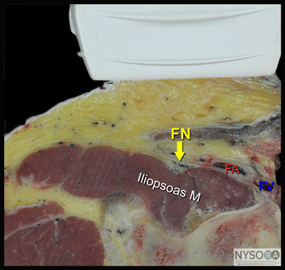 nysora - the new york school of regional anesthesia - ultrasound nysora - the new york school of regional anesthesia - ultrasound, Muscles