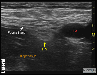 nysora - the new york school of regional anesthesia - ultrasound nysora - the new york school of regional anesthesia - ultrasound, Muscles