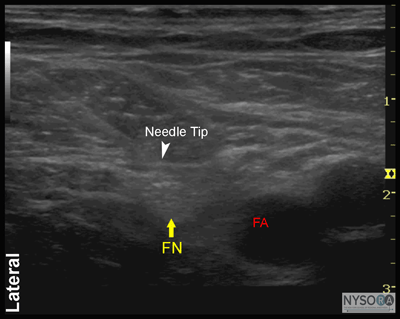nysora - the new york school of regional anesthesia - ultrasound nysora - the new york school of regional anesthesia - ultrasound, Muscles