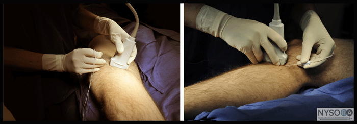 UltrasoundGuided Saphenous Nerve Block NYSORA The New
