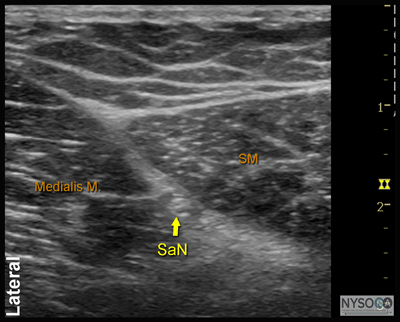 Ultrasound-Guided Saphenous Nerve Block - NYSORA The New York School of