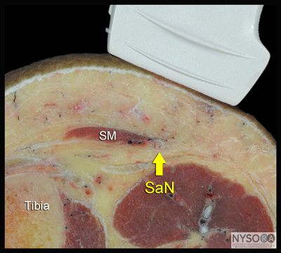 Ultrasound-Guided Saphenous Nerve Block - NYSORA The New York School of