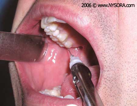 Akinosi+Injection+Technique Figure 20B: The needle is then moved distally and is held parallel to ...