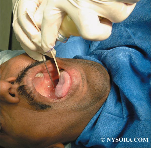 topical anesthesia Topical anesthesia is defined as superficial loss of sensation in conjunctiva, mucous membranes, or skin, produced by direct application of local anesthetic solutions, ointments, gels or sprays. topical anesthesia Topical anesthesia is defined as superficial loss of sensation in conjunctiva, mucous membranes, or skin, produced by direct application of local anesthetic solutions, ointments, gels or sprays.