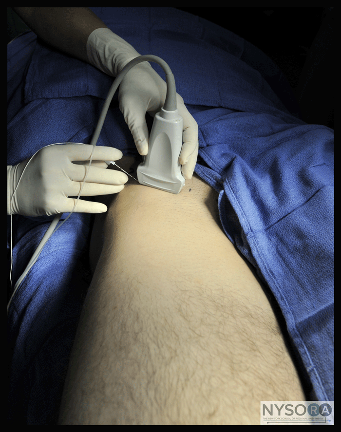 Ultrasound-Guided Fascia Iliaca Block - NYSORA The New York School of