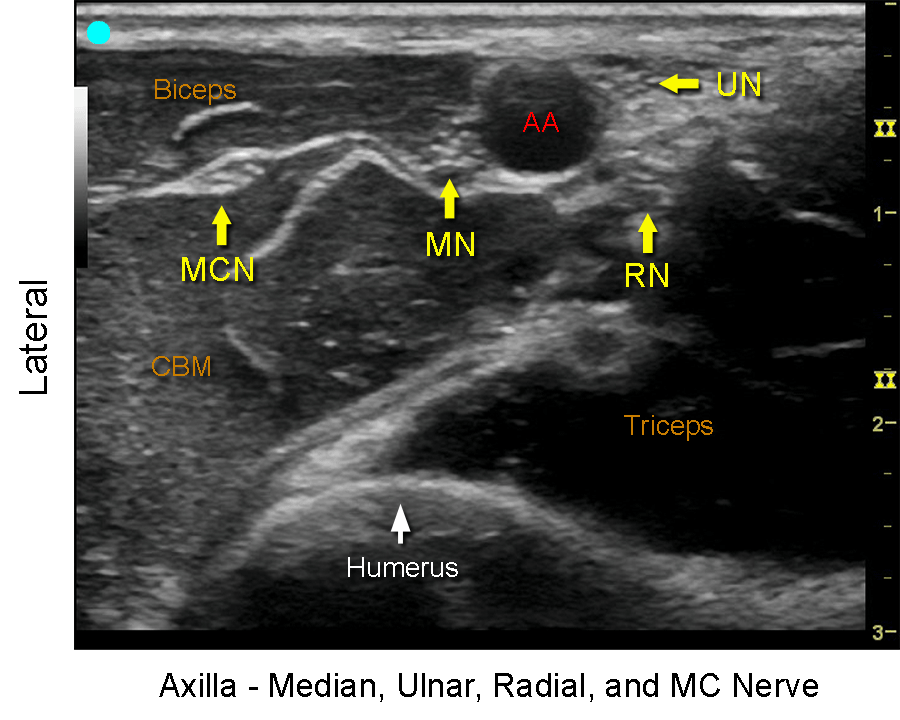 Axillary Brachial Plexus_Transducer position, US images and Crossection