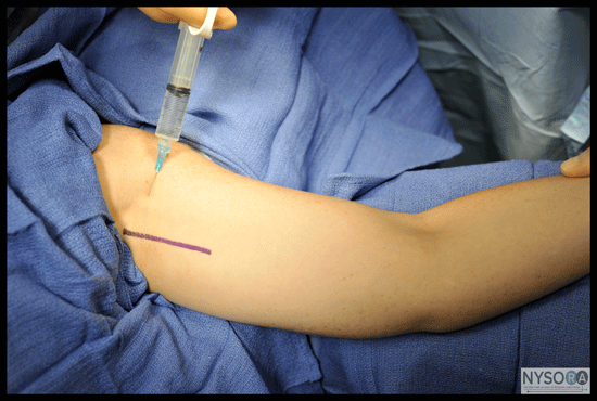 Cutaneous Nerve blocks of the Upper Extremity - NYSORA The New York