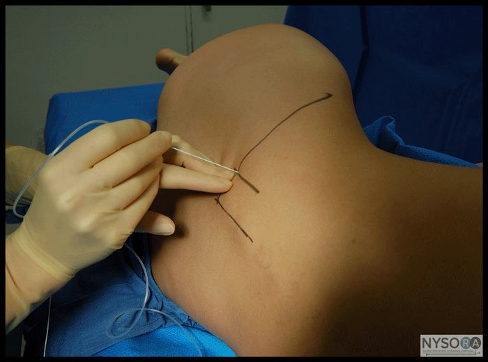 Lumbar Plexus Block - NYSORA The New York School of Regional Anesthesia