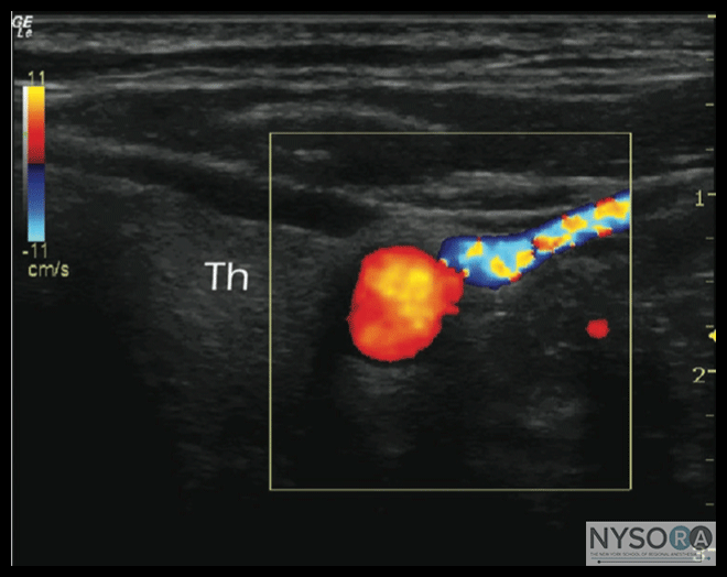 Ultrasound Physics NYSORA The New York School of