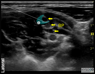 Ultrasound-Guided Interscalene Brachial Plexus Block - NYSORA The New