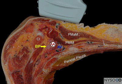 pec block
