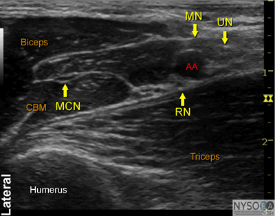 Ultrasound-Guided Axillary Brachial Plexus Block - NYSORA The New York