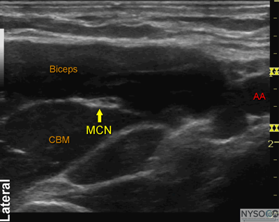 Ultrasound-Guided Axillary Brachial Plexus Block - NYSORA The New York