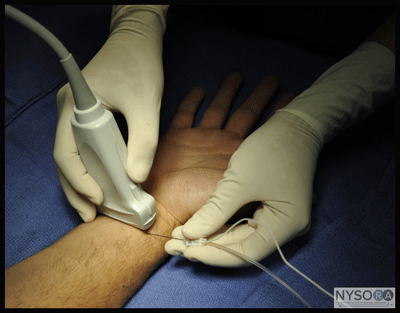 Ultrasound-Guided Wrist Block - NYSORA The New York School of Regional