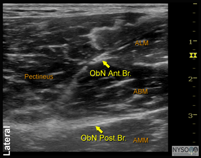 Ultrasound Guided Obturator Nerve Block - NYSORA The New York School of