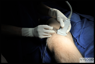 Ultrasound-Guided Saphenous Nerve Block - NYSORA The New York School of