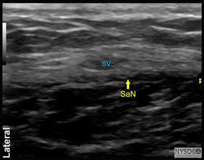 Ultrasound-Guided Saphenous Nerve Block - NYSORA The New York School of