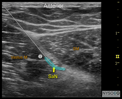 Ultrasound-Guided Saphenous Nerve Block - NYSORA The New York School of