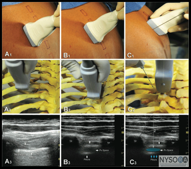 Thoracic Paravertebral Block - NYSORA The New York School of Regional