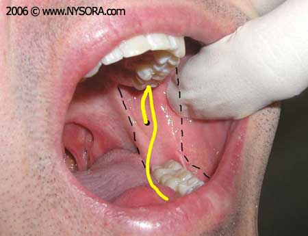 inferior alveolar nerve block