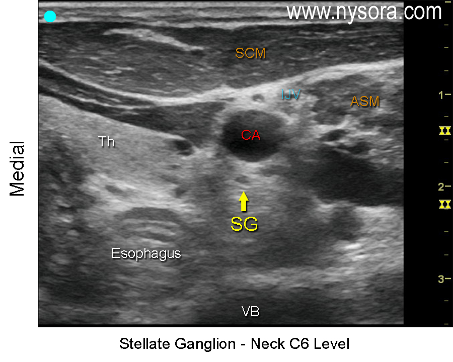 Stellate Ganglion - NYSORA The New York School of Regional Anesthesia