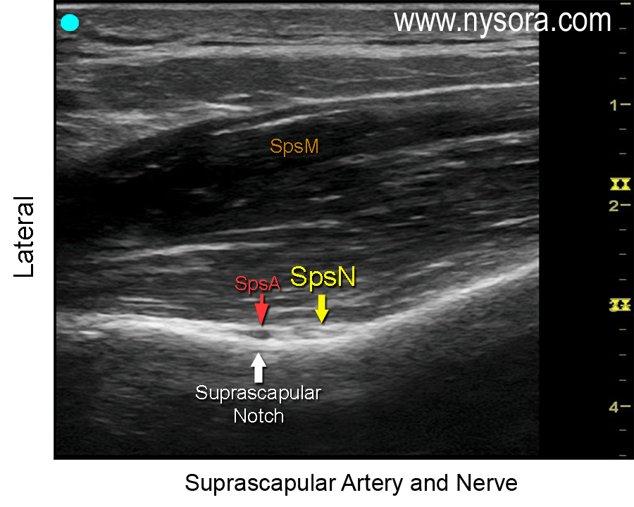 Suprascapular Nerve - NYSORA The New York School of Regional Anesthesia