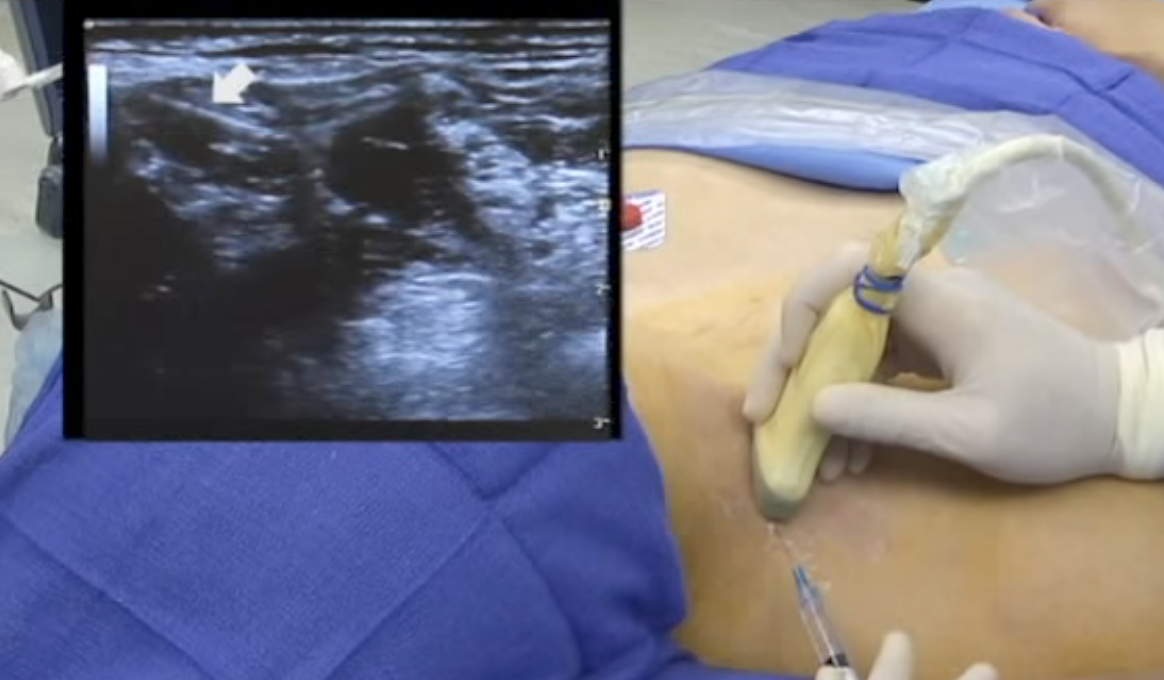 Ultrasound-Guided Interscalene Brachial Plexus Block Video - NYSORA The
