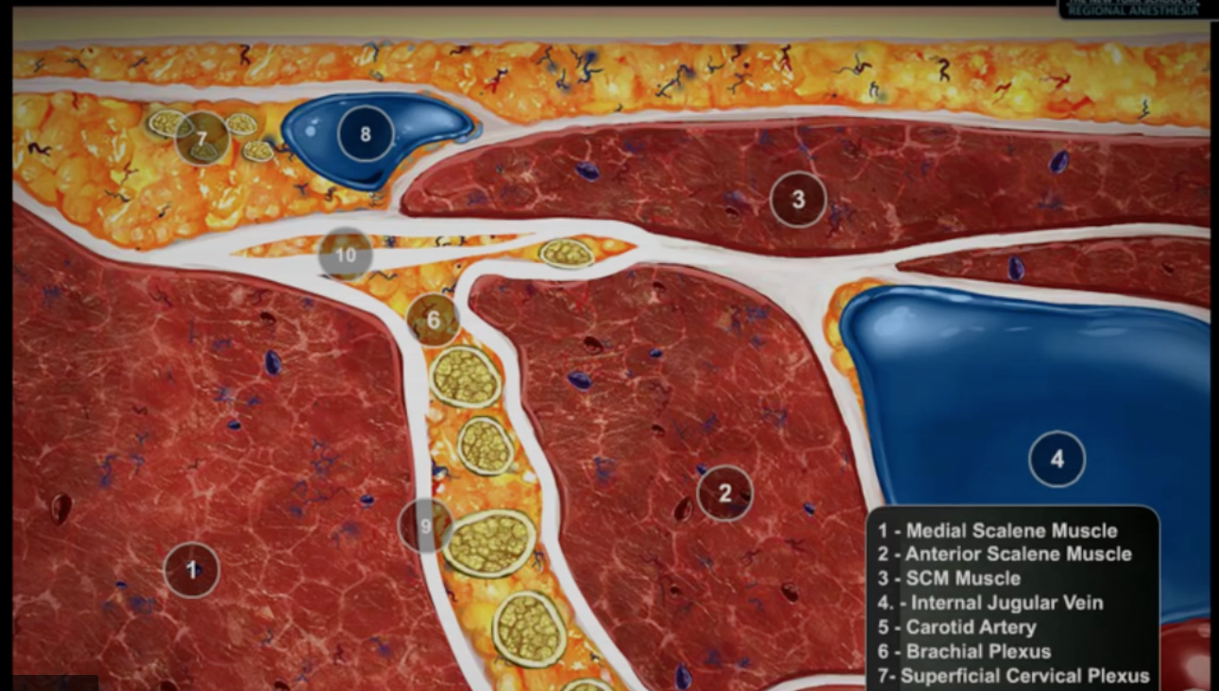 Ultrasound-Guided Interscalene Brachial Plexus Block Video - NYSORA The