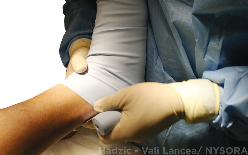 Intravenous Regional Block for Upper and Lower Extremity Surgery