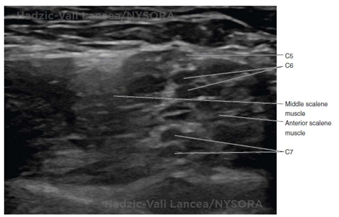 UltrasoundGuided Interscalene Brachial Plexus Block NYSORA The New
