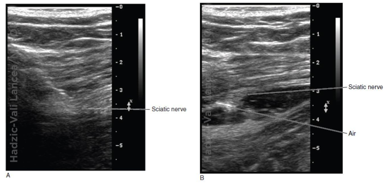 Optimizing an Ultrasound Image NYSORA The New York School of Regional