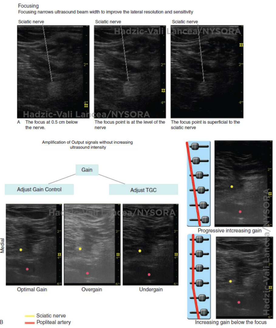 Optimizing an Ultrasound Image NYSORA The New York School of Regional