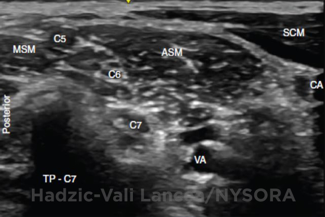 Ultrasound-Guided Interscalene Brachial Plexus Block - NYSORA The New