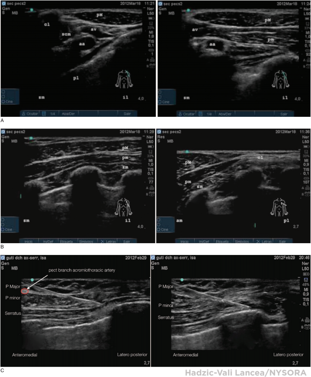 pec block