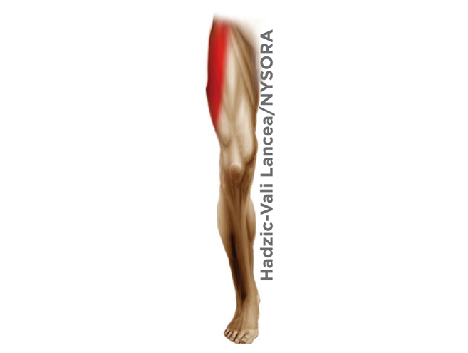 Lateral Femoral Cutaneous Nerve Block