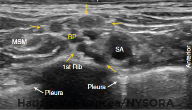 Ultrasound-Guided Supraclavicular Brachial Plexus Block - NYSORA The