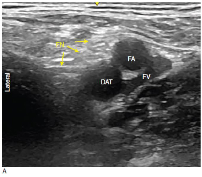 Ultrasound-Guided Femoral Nerve Block - NYSORA The New York School of
