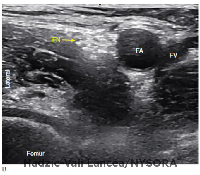 Ppt Lower Extremity And Trunk Ultrasound Guided Blocks