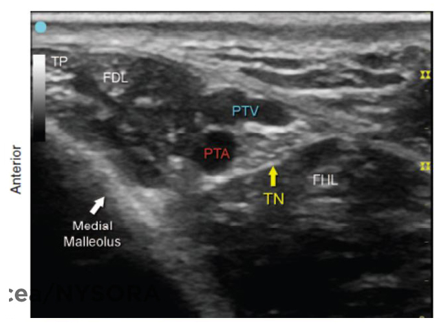 Tibial Nerve Block Ultrasound