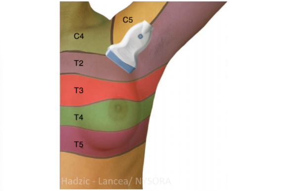 pec block