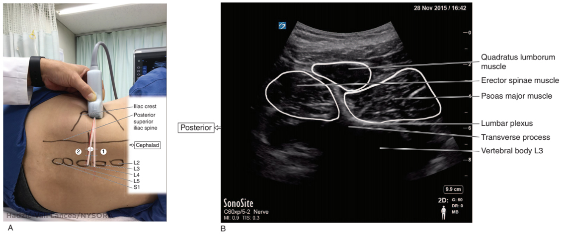 Sonography of the Lumbar Paravertebral Space and Considerations for