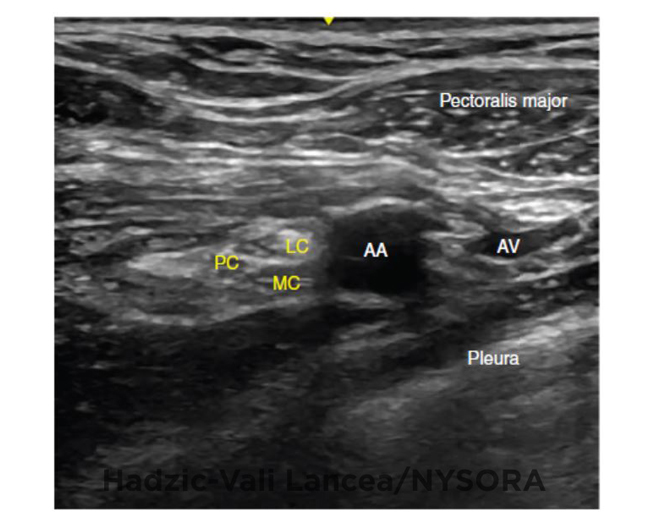 UltrasoundGuided Infraclavicular Brachial Plexus Block NYSORA The
