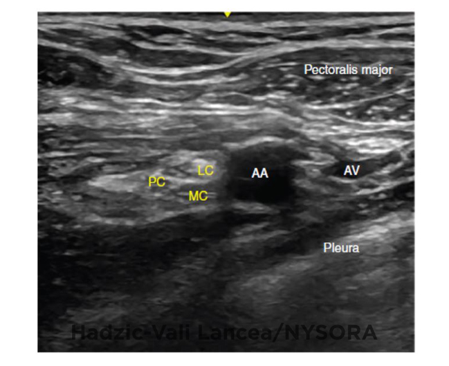 Ultrasound Guided Infraclavicular Brachial Plexus Block Nysora The