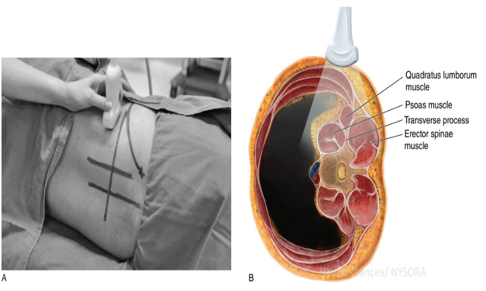Lumbar Paravertebral Sonography and Considerations for Ultrasound