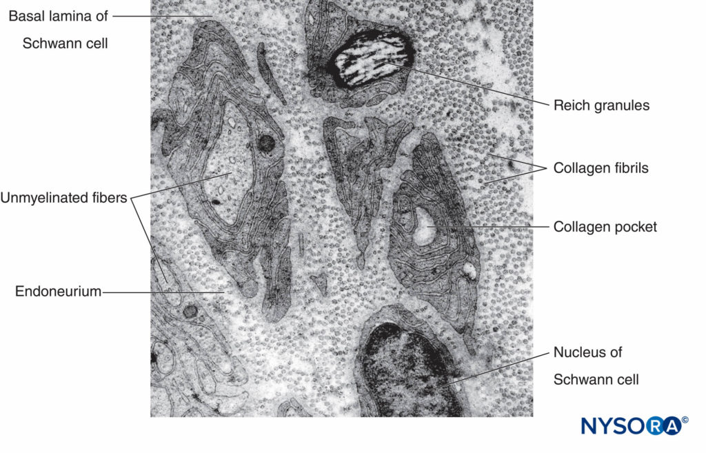 Electron micrograph of unmyelinated axons. Biopsy of human sural nerve.